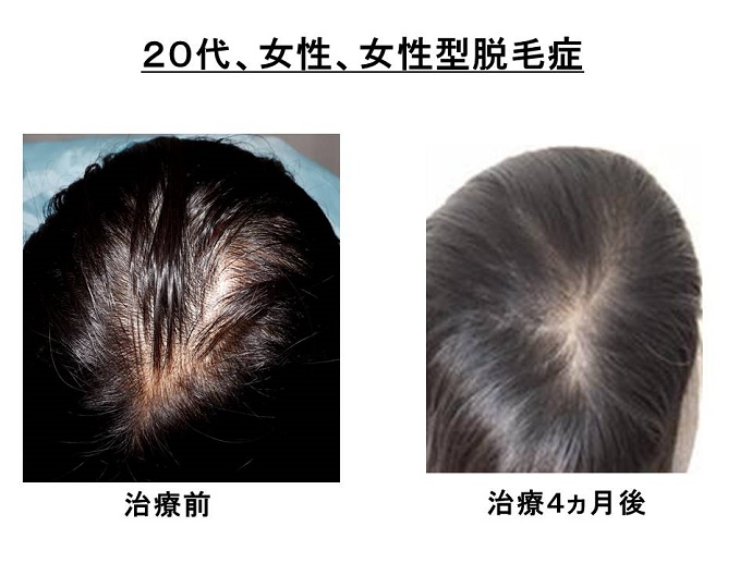 円形脱毛症　病院